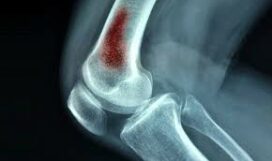 гематогенный остеомиелит у детей