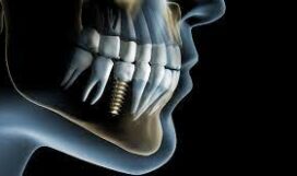 технологии протезирования на дентальных имплантах